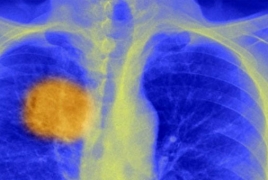 «Убивая» рак: Ученые хотят победить болезнь, настроив против нее иммунную систему человека