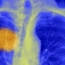 «Убивая» рак: Ученые хотят победить болезнь, настроив против нее иммунную систему человека
