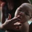 U.S. health experts confirm that Zika causes severe birth defects