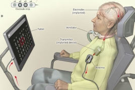 Paralyzed woman can now communicate through brain implant