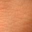 В Белоруссии разработали технологию выращивания человеческой кожи из клеток кожи пациента
