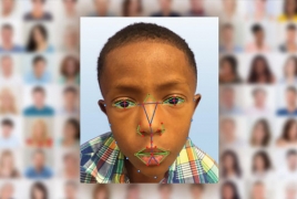 Facial recognition to help doctors detect rare genetic disease