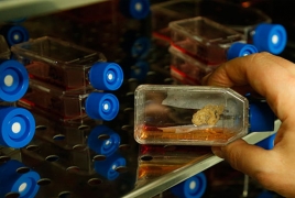 Man receives “reprogrammed” stem cells from another person