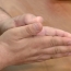 Armenian man cuts off thumb in U.S., has it replaced with a big toe