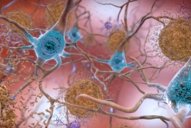 Positive test results revives hopes for Alzheimer’s treatment