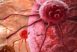 Stem cell treatment of cancer enters clinical trial in U.S.