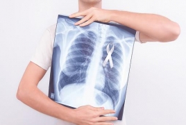Study unveils potential new treatment approach for lung cancer