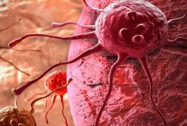 Breast cancer cells 'stick together' to spread through body: study